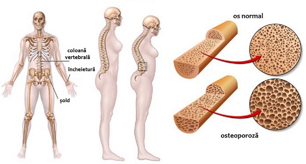 tratamentul osteoporozei coloanei cervicale